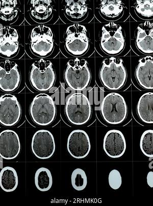 TDM multi-coupes du cerveau montrant un gros tronc cérébral et un hématome sémioval au centre droit, des structures de fosse postérieure normales, une taille normale du vent Banque D'Images