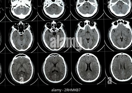 TDM multi-coupes du cerveau montrant un gros tronc cérébral et un hématome sémioval au centre droit, des structures de fosse postérieure normales, une taille normale du vent Banque D'Images