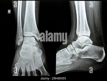 Radiographie directe AP vues latérales de la cheville droite montrant une entorse syndesmotique de la cheville, une blessure à un ou plusieurs ligaments comprenant le tibiofib distal Banque D'Images