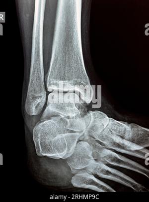 Vue en mortaise radiographique simple de la cheville droite montrant une entorse syndesmotique de la cheville, une blessure à un ou plusieurs ligaments comprenant le tibiofibulaire distal Banque D'Images