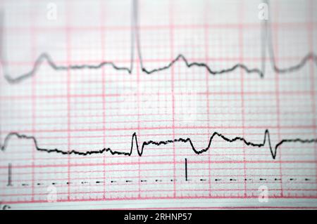 Un ECG d'électrocardiographe, un graphique qui tire l'électricité du cœur et donne une idée de la condition cardiaque et du rythme et exclut tout an Banque D'Images