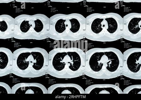 TDM multi-coupes du thorax montrant une étude normale, un aspect normal des poumons, un parenchyme, une vascularisation pulmonaire, des structures médiastinales, non Banque D'Images
