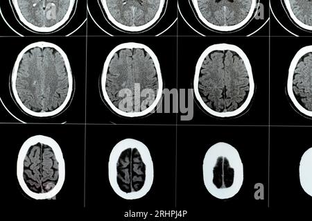 TDM multi-coupes du cerveau montrant un gros tronc cérébral et un hématome sémioval au centre droit, des structures de fosse postérieure normales, une taille normale du vent Banque D'Images