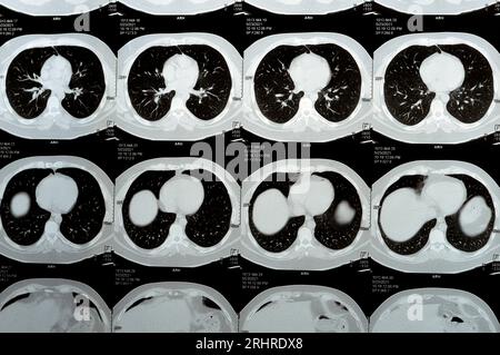 TDM multi-coupes du thorax montrant une étude normale, un aspect normal des poumons, un parenchyme, une vascularisation pulmonaire, des structures médiastinales, non Banque D'Images