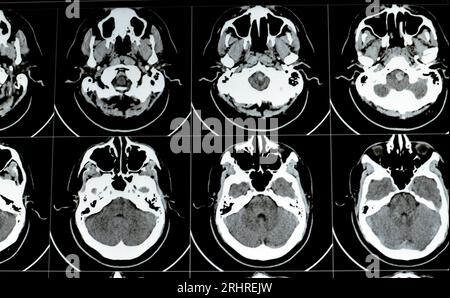 TDM multi-coupes du cerveau montrant un gros tronc cérébral et un hématome sémioval au centre droit, des structures de fosse postérieure normales, une taille normale du vent Banque D'Images