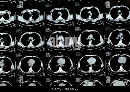 TDM multi-coupes du thorax montrant une étude normale, un aspect normal des poumons, un parenchyme, une vascularisation pulmonaire, des structures médiastinales, non Banque D'Images