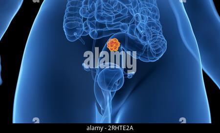 Cancer du côlon, illustration Banque D'Images