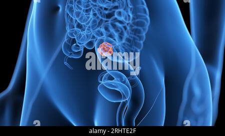 Cancer du côlon, illustration Banque D'Images