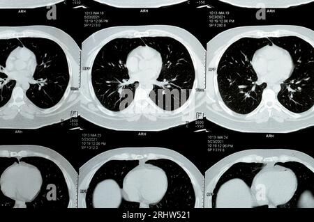 TDM multi-coupes du thorax montrant une étude normale, un aspect normal des poumons, un parenchyme, une vascularisation pulmonaire, des structures médiastinales, non Banque D'Images