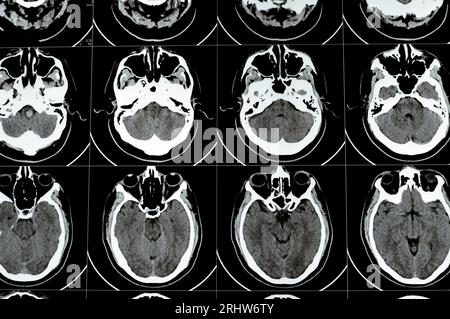 TDM multi-coupes du cerveau montrant un gros tronc cérébral et un hématome sémioval au centre droit, des structures de fosse postérieure normales, une taille normale du vent Banque D'Images