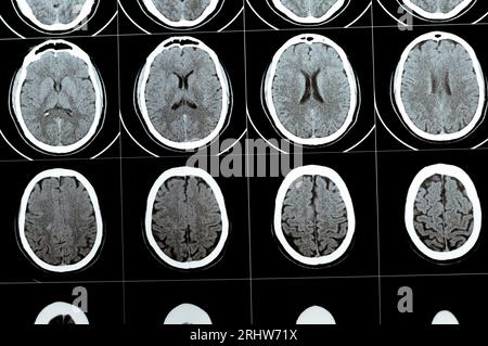 TDM multi-coupes du cerveau montrant un gros tronc cérébral et un hématome sémioval au centre droit, des structures de fosse postérieure normales, une taille normale du vent Banque D'Images