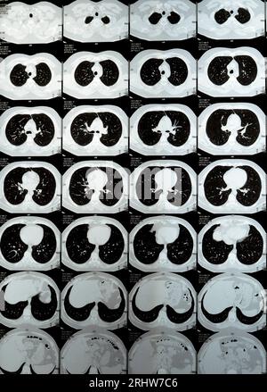 TDM multi-coupes du thorax montrant une étude normale, un aspect normal des poumons, un parenchyme, une vascularisation pulmonaire, des structures médiastinales, non Banque D'Images