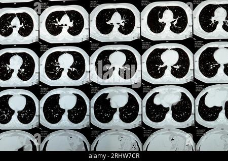 TDM multi-coupes du thorax montrant une étude normale, un aspect normal des poumons, un parenchyme, une vascularisation pulmonaire, des structures médiastinales, non Banque D'Images