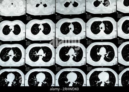TDM multi-coupes du thorax montrant une étude normale, un aspect normal des poumons, un parenchyme, une vascularisation pulmonaire, des structures médiastinales, non Banque D'Images
