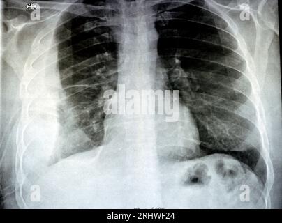 Radiographie simple pour un patient atteint d'une pneumonie par aspiration du poumon droit, d'un empyème, d'un épanchement pleural après insertion d'un tube de thoracostomie thoracique pour drainer l'up Banque D'Images