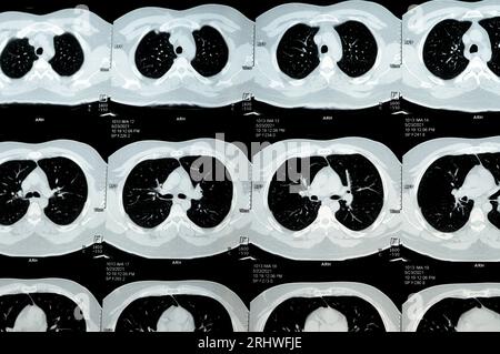 TDM multi-coupes du thorax montrant une étude normale, un aspect normal des poumons, un parenchyme, une vascularisation pulmonaire, des structures médiastinales, non Banque D'Images