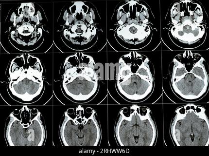 TDM multi-coupes du cerveau montrant un gros tronc cérébral et un hématome sémioval au centre droit, des structures de fosse postérieure normales, une taille normale du vent Banque D'Images