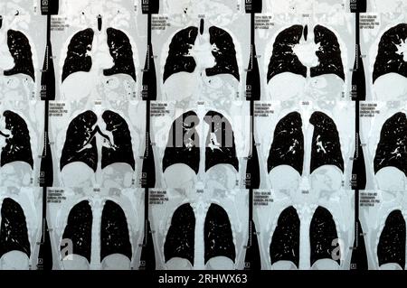 TDM multi-coupes du thorax montrant une étude normale, un aspect normal des poumons, un parenchyme, une vascularisation pulmonaire, des structures médiastinales, non Banque D'Images