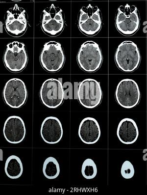 TDM cérébrale montrant un cavernome du tronc cérébral, une anomalie veineuse développementale du centre sémiovale droit, un hématome intra-cérébral, une légère lésion hypodense en M. Banque D'Images