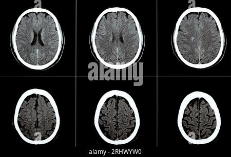 TDM cérébrale montrant un cavernome du tronc cérébral, une anomalie veineuse développementale du centre sémiovale droit, un hématome intra-cérébral, une légère lésion hypodense en M. Banque D'Images