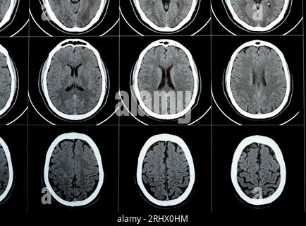 TDM multi-coupes du cerveau montrant un gros tronc cérébral et un hématome sémioval au centre droit, des structures de fosse postérieure normales, une taille normale du vent Banque D'Images