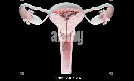 Tumeur maligne de l'utérus, anatomie de l'utérus féminin, système reproductif, cellules cancéreuses, kystes des ovaires, cancer du col de l'utérus, cellules en croissance, maladie gynécologique Banque D'Images