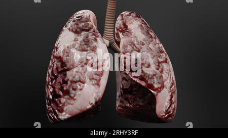Pneumonie maladie, poumons sains et maladies poumons, cancer des poumons humains, fumeurs de cigarettes maladie pulmonaire, tumeur maligne cancéreuse en croissance et propagation Banque D'Images