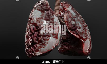 Pneumonie maladie, poumons sains et maladies poumons, cancer des poumons humains, fumeurs de cigarettes maladie pulmonaire, tumeur maligne cancéreuse en croissance et propagation Banque D'Images