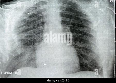 Radiographie thoracique simple montrant une pneumonie du processus pulmonaire infectieux avec épanchement para-pneumonique minimal du côté droit, pneumonie par aspiration du côté droit Banque D'Images