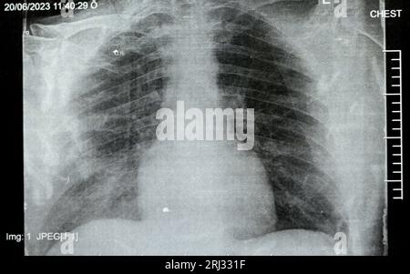 Radiographie thoracique simple montrant une pneumonie du processus pulmonaire infectieux avec épanchement para-pneumonique minimal du côté droit, pneumonie par aspiration du côté droit Banque D'Images