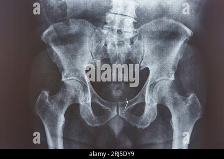 Radiographie de la hanche. Fil d'or attaché sur l'os. Examen médical Banque D'Images