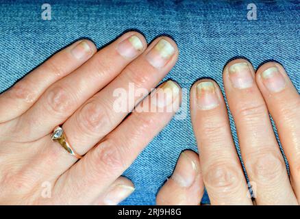 Infection fongique des ongles, onycholyse après shellac ou gel-vernis Banque D'Images