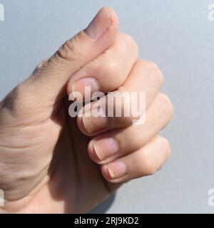 Infection fongique des ongles, onycholyse après shellac ou gel-vernis Banque D'Images