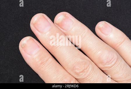 Infection fongique des ongles, onycholyse après shellac ou gel-vernis Banque D'Images