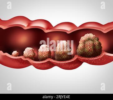 Stades du cancer Prognose et progression tumorale métastase Colon ou cancer colorectal concept comme illustration médicale avec une croissance tumorale maligne Banque D'Images