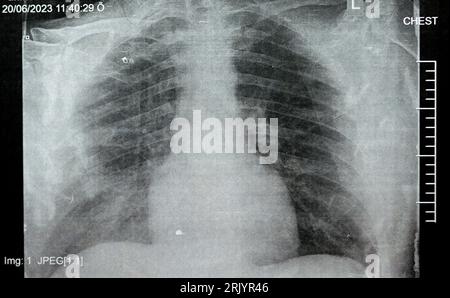 Radiographie thoracique simple montrant une pneumonie du processus pulmonaire infectieux avec épanchement para-pneumonique minimal du côté droit, pneumonie par aspiration du côté droit Banque D'Images