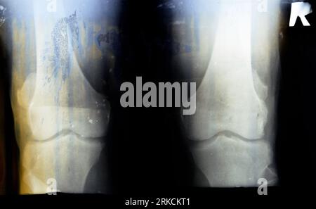 La vieille radiographie rétro Plain du genou droit montre une arthrose articulaire apparente par le système Kellgren et Lawrence pour la classification de l'arthrose avec Banque D'Images