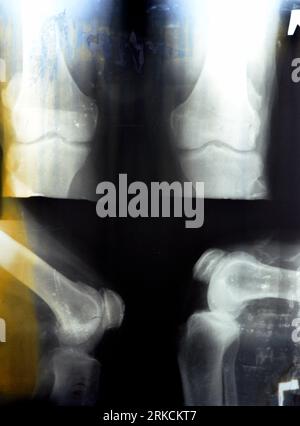 La vieille radiographie rétro Plain du genou droit montre une arthrose articulaire apparente par le système Kellgren et Lawrence pour la classification de l'arthrose avec Banque D'Images