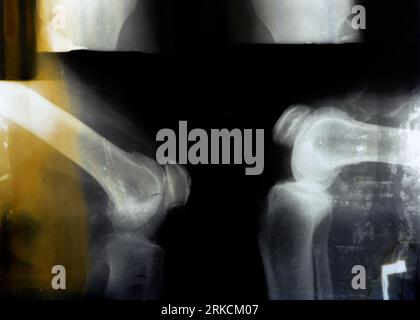 La vieille radiographie rétro Plain du genou droit montre une arthrose articulaire apparente par le système Kellgren et Lawrence pour la classification de l'arthrose avec Banque D'Images