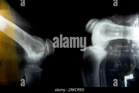 La vieille radiographie rétro Plain du genou droit montre une arthrose articulaire apparente par le système Kellgren et Lawrence pour la classification de l'arthrose avec Banque D'Images