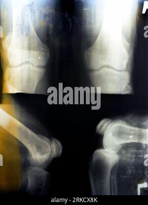 La vieille radiographie rétro Plain du genou droit montre une arthrose articulaire apparente par le système Kellgren et Lawrence pour la classification de l'arthrose avec Banque D'Images