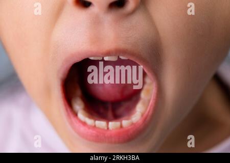 Headshot image recadrée de mignonne fille d'âge préscolaire souriant large montrant des dents de lait. Gros plan des dents blanches d'un enfant. Banque D'Images