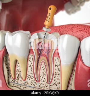 Section transversale de dent humaine avec lime rotative endodontique. illustration 3d. Banque D'Images