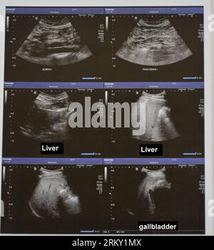 Échographie de l'abdomen supérieur avec visualisation des parties de l'aorte, du pancréas, du foie et de la vésicule biliaire Banque D'Images