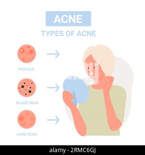 Différents types d'acné de la peau du visage. Pustule, points noirs et cicatrices d'acné illustration vectorielle plate Illustration de Vecteur