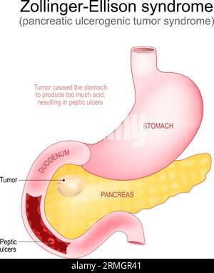 Syndrome de Zollinger-Ellison. Le gastrinome est une tumeur développée dans le pancréas qui a causé des ulcères peptiques dans le duodénum. Partie du système digestif humain. Illustration de Vecteur