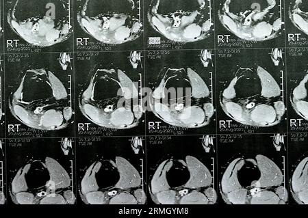 IRM du genou droit montrant un léger épanchement articulaire, avec d'autres résultats normaux de PHMM, LCA, MCL, LCL, LM, ligaments, rotule, tendons, nerfs, muscles Banque D'Images