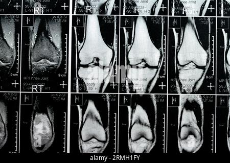 IRM du genou droit montrant un léger épanchement articulaire, avec d'autres résultats normaux de PHMM, LCA, MCL, LCL, LM, ligaments, rotule, tendons, nerfs, muscles Banque D'Images