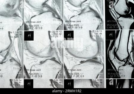 IRM du genou droit montrant un léger épanchement articulaire, avec d'autres résultats normaux de PHMM, LCA, MCL, LCL, LM, ligaments, rotule, tendons, nerfs, muscles Banque D'Images