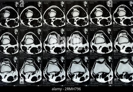 IRM du genou droit montrant un léger épanchement articulaire, avec d'autres résultats normaux de PHMM, LCA, MCL, LCL, LM, ligaments, rotule, tendons, nerfs, muscles Banque D'Images